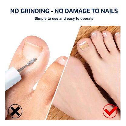 Ingrown Toenail Corrector Stickers – Pain Relief & Nail Correction Strips